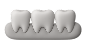 Strengthening enamel post-orthodontics or whitening